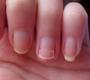 ناخن ها درباره سلامتی شما چه می گویند